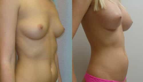 breast-augmentation-paciente-1-2-1024x741