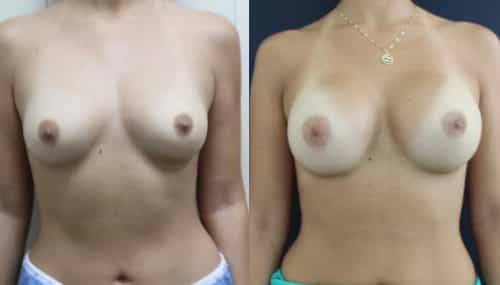 breast-augmentation-paciente-3-1-1024x629