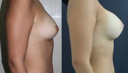 breast-augmentation-paciente-3-3-1024x741