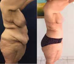 before and after body lift in colombia