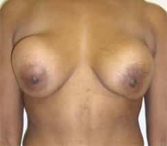 before and after breast revision in colombia