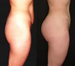before and after butt implants in colombia