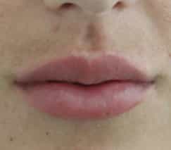 before and after lip enhancement in colombia