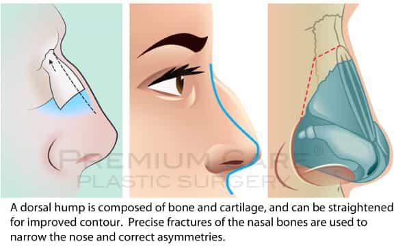 Rhinoplasty in Colombia