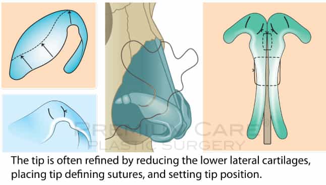 Rhinoplasty in Colombia