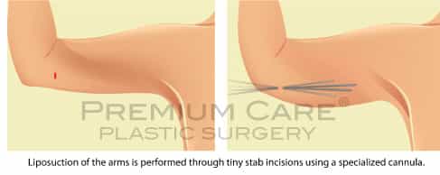 Arm lift Colombia - Premium Care Plastic Surgery Arm lift Colombia - Premium Care Plastic Surgery