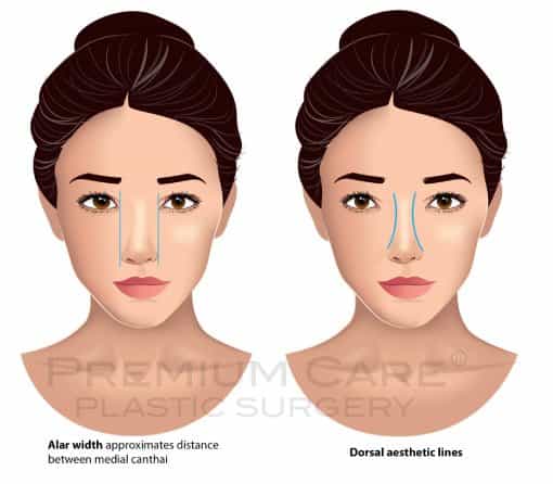 Rhinoplasty in Colombia