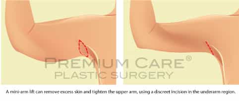 Arm lift Colombia - Premium Care Plastic Surgery Arm lift Colombia - Premium Care Plastic Surgery