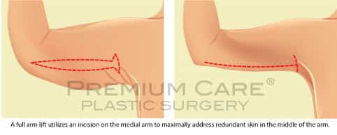 Arm lift Colombia - Premium Care Plastic Surgery Arm lift Colombia - Premium Care Plastic Surgery