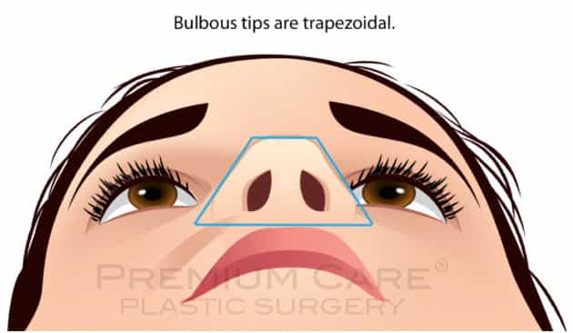 Rhinoplasty in Colombia -Surgery