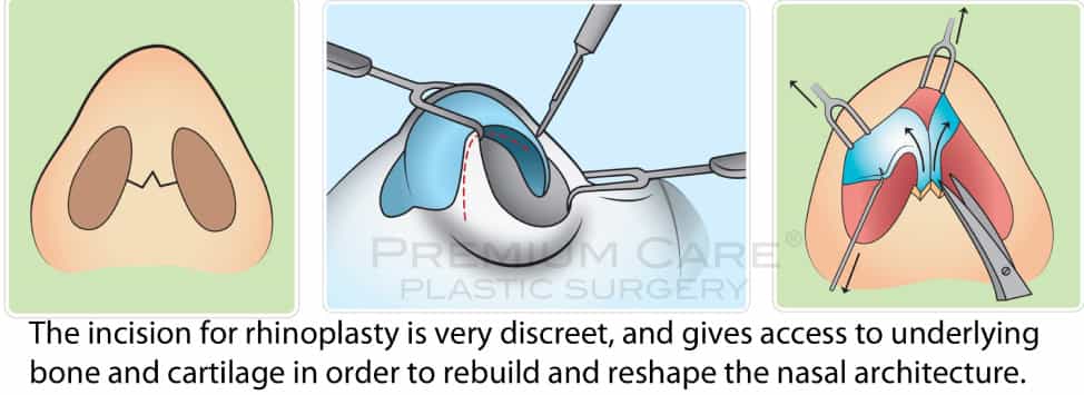 Rhinoplasty in Colombia