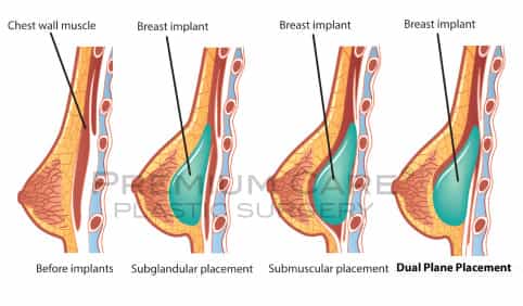 Breast Augmentation in Colombia-position Breast Augmentation in Colombia