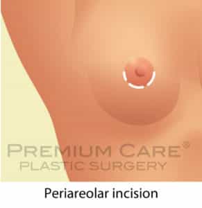 Breast Augmentation in Colombia Breast Augmentation in Colombia