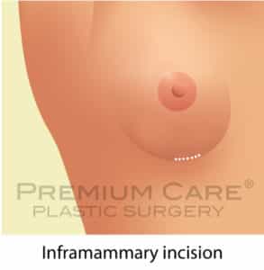 Breast Augmentation in Colombia Breast Augmentation in Colombia