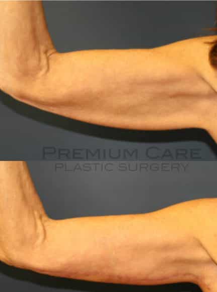 Arm lift Colombia - Premium Care Plastic Surgery