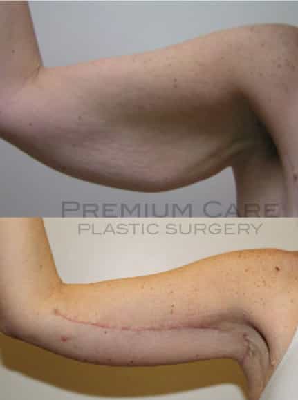 Arm lift Colombia - Premium Care Plastic Surgery Arm lift Colombia - Premium Care Plastic Surgery