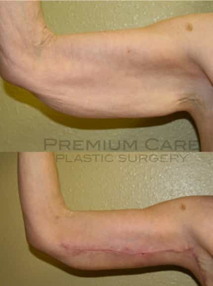 Arm lift Colombia - Premium Care Plastic Surgery Arm lift Colombia - Premium Care Plastic Surgery