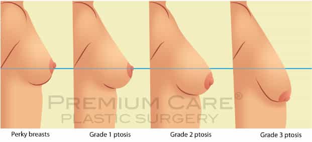 Breast Lift in Colombia - Premium Care Plastic Surgery