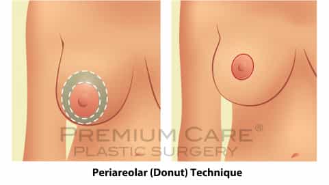 Breast Lift in Colombia - Premium Care Plastic Surgery - Periareolar Donut Technique