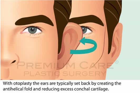 Ear Surgery - Premium Care Plastic Surgery