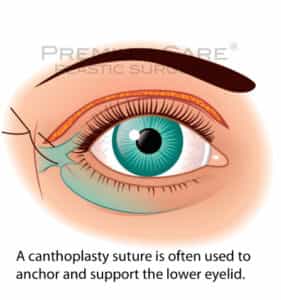 Eyelid Surgery in Colombia Eyelid Surgery in Colombia