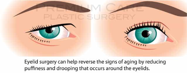 Eyelid Surgery in Colombia
