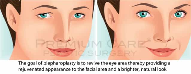 Eyelid Surgery in Colombia Eyelid Surgery in Colombia