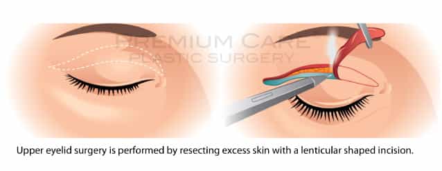 Eyelid Surgery in Colombia Eyelid Surgery in Colombia