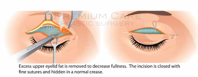 Eyelid Surgery in Colombia Eyelid Surgery in Colombia