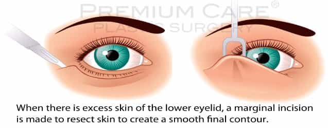 Eyelid Surgery in Colombia Eyelid Surgery in Colombia