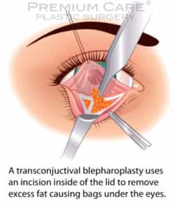 Eyelid Surgery in Colombia Eyelid Surgery in Colombia