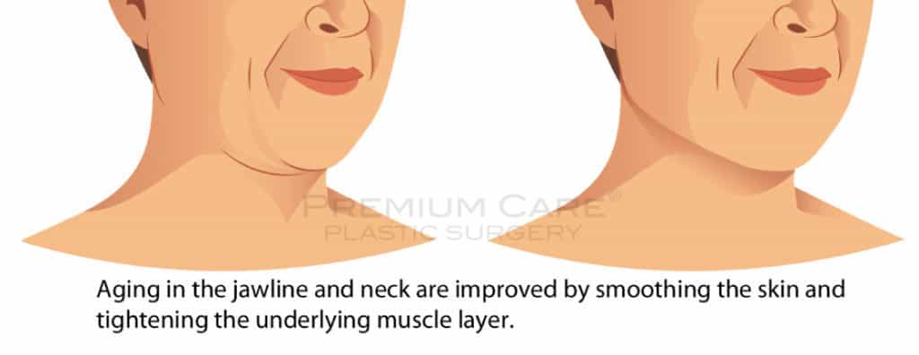 Neck Lift in Colombia -Premium-Care-Plastic-Surgery