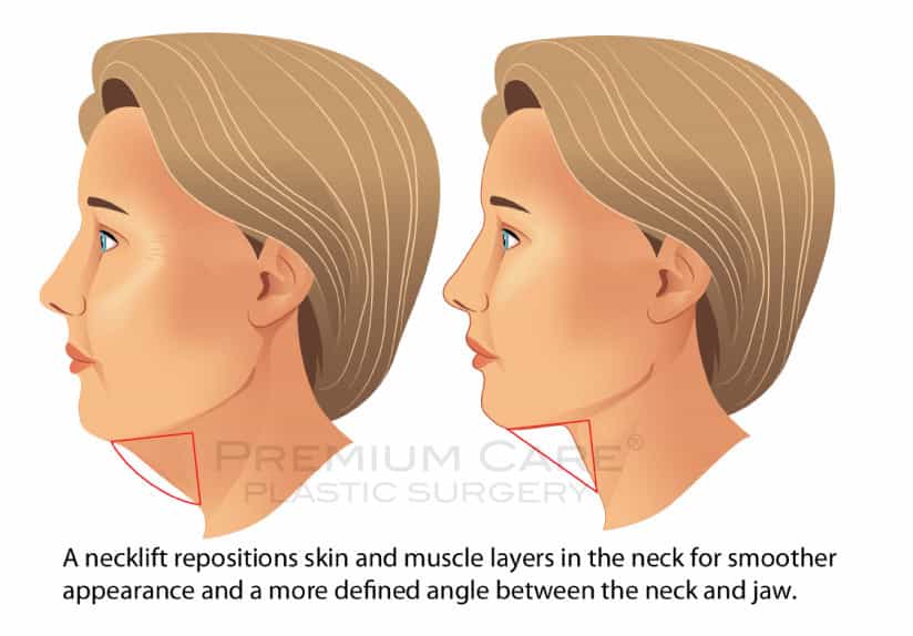 Neck Lift in Colombia -Premium-Care-Plastic-Surgery