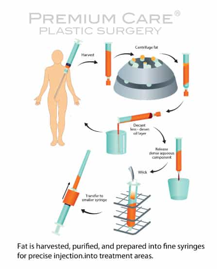 Facial Sculpting in Colombia - Facial-Fat-Grafting-preparation-1 Facial Sculpting in Colombia - Facial-Fat-Grafting-Preparation