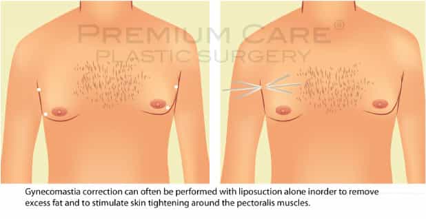 Male breast reduction Colombia - Premium Care Plastic Surgery Male breast reduction Colombia - Premium Care Plastic Surgery
