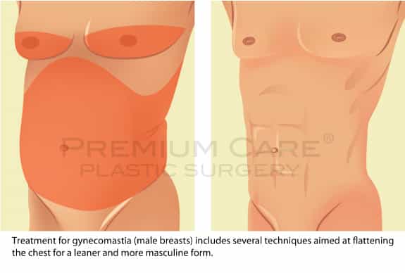 Male breast reduction Colombia - Premium Care Plastic Surgery Male breast reduction Colombia - Premium Care Plastic Surgery