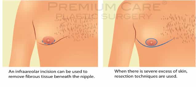Male breast reduction Colombia - Premium Care Plastic Surgery