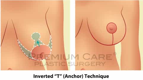 Inverted-technique-breast-surgery Breast Lift in Colombia - Premium Care Plastic Surgery - Inverted Technique
