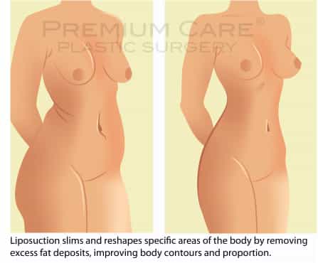 Liposuction in Colombia - Premium Care Plastic Surgeryn-premium-care-plastic-surgery Liposuction in Colombia - Premium Care Plastic Surgery