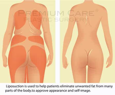 Liposuction in Colombia - Premium Care Plastic Surgery