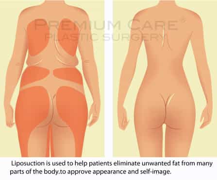 Liposuction in Colombia - Premium Care Plastic Surgery Liposuction in Colombia - Premium Care Plastic Surgery