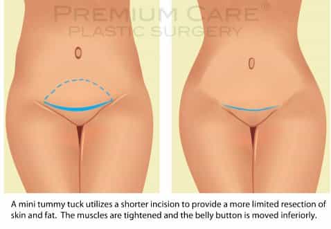 Tummy Tuck in Colombia - mini tummy tuck Tummy Tuck in Colombia - mini tummy tuck