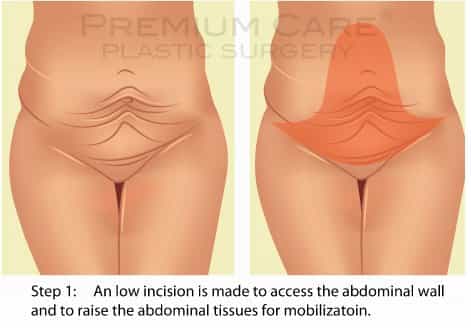 Tummy Tuck in Colombia - technique Tummy Tuck in Colombia - technique