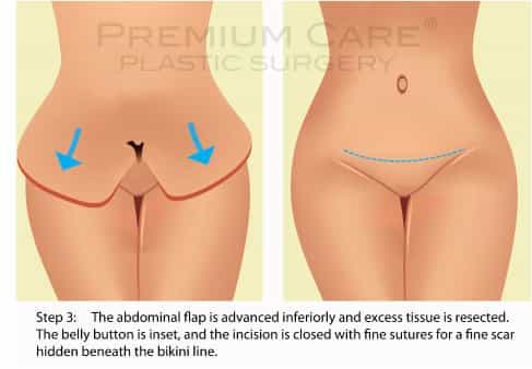Tummy Tuck in Colombia - technique3 Tummy Tuck in Colombia - technique 3