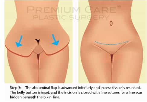 Having Lipo in Mon Pubis After Tummy Tuck: Will Lipo be Enough and