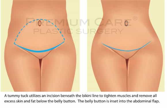 Tummy Tuck in Colombia Tummy Tuck in Colombia