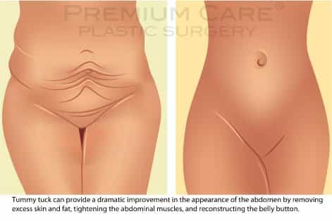 Tummy Tuck in Colombia - before and after