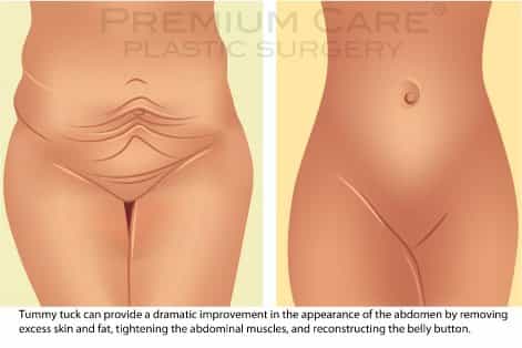 Tummy Tuck in Colombia - before and after Tummy Tuck in Colombia - before and after