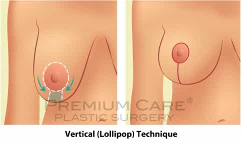 Breast Lift in Colombia - Premium Care Plastic Surgery - Vertical (Lollipop) Technique