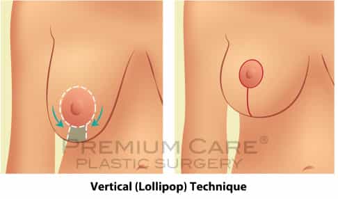 Vertical-technique-Breast Breast Lift in Colombia - Premium Care Plastic Surgery - Vertical (Lollipop) Technique